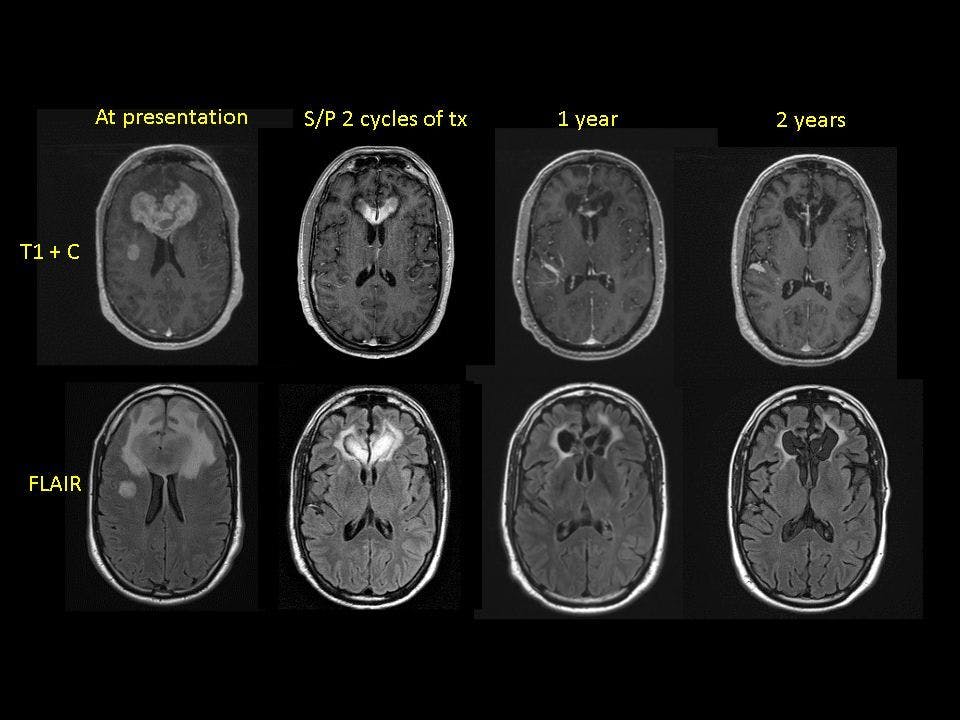Neurocognitive Outcomes in Primary CNS Lymphoma: Clinical Implications