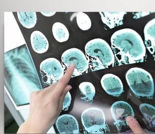 Concussions in Adolescence and Risk of Multiple Sclerosis